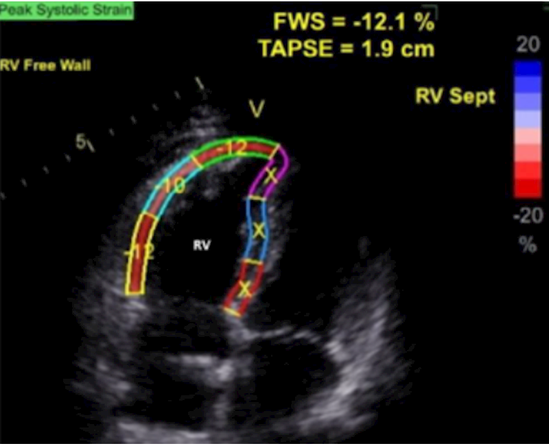 Evolving deformation patterns in a competitive swimmer with low QRS voltages on 12-lead electrocardiogram